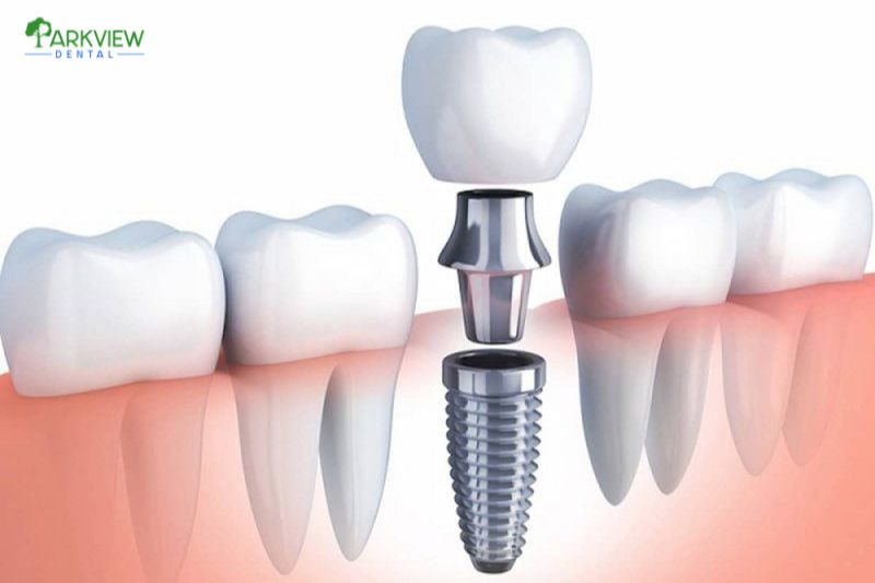 Trồng răng sứ trên Implant tại Nha Khoa Parkview