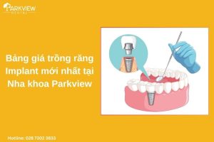 bảng giá trồng răng implant