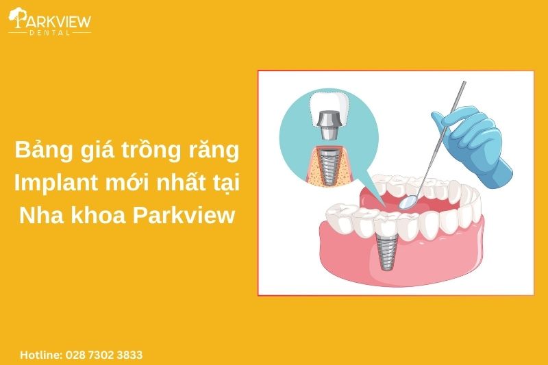 bảng giá trồng răng implant