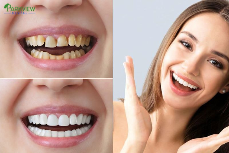 Hình ảnh trước và sau khi bọc răng sứ