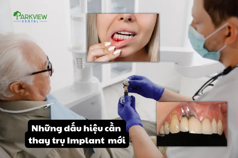 Các dấu hiệu cần thay trụ Implant mới