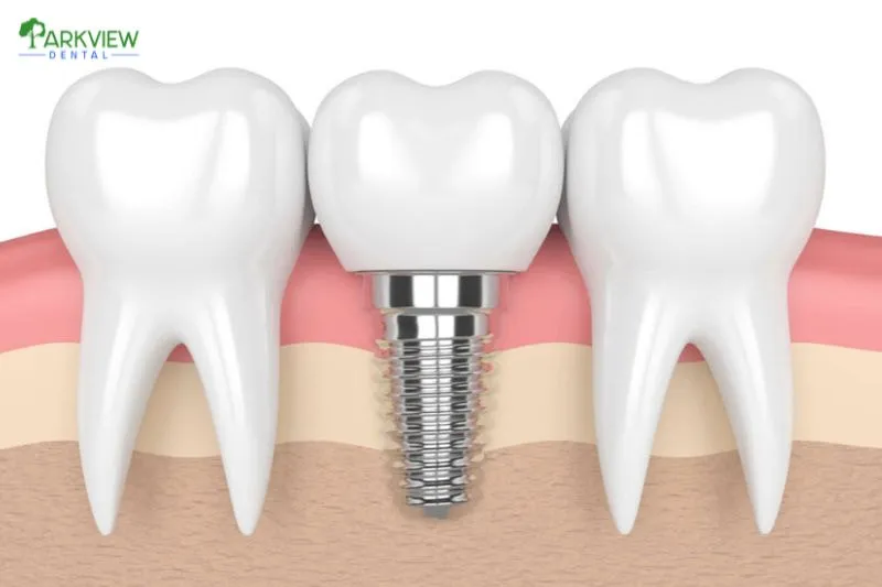Các yếu tố ảnh hưởng đến chi phí trồng răng Implant