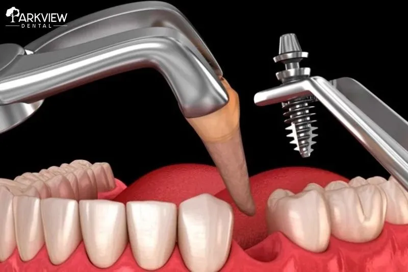 Các yếu tố ảnh hưởng đến thời gian trồng răng Implant