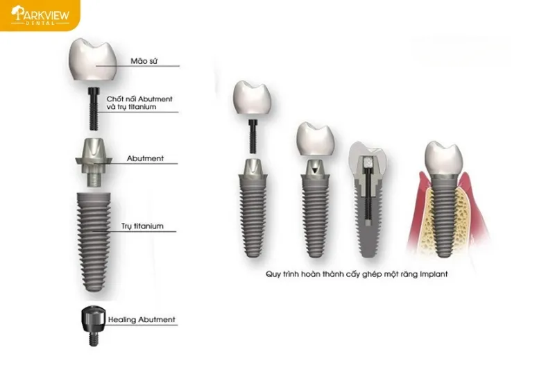 Cấu tạo của trụ Implant