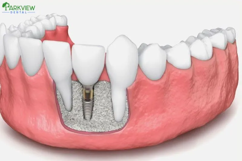 Hình ảnh minh họa cấy ghép Implant