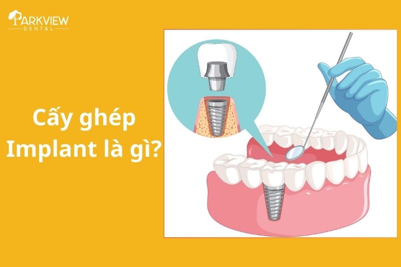 Cấy ghép Implant