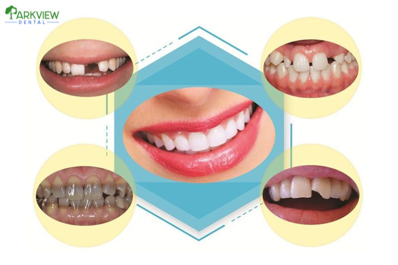 Những trường hợp nên và không nên bọc răng sứ