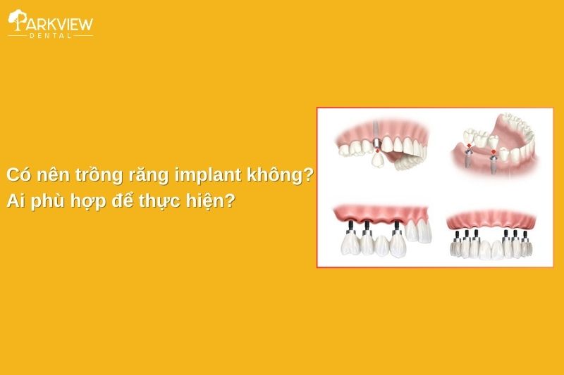 có nên trồng răng implant không