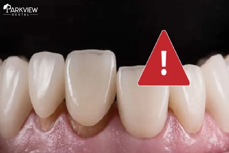 Dấu hiệu cảnh báo răng sứ có vấn đề