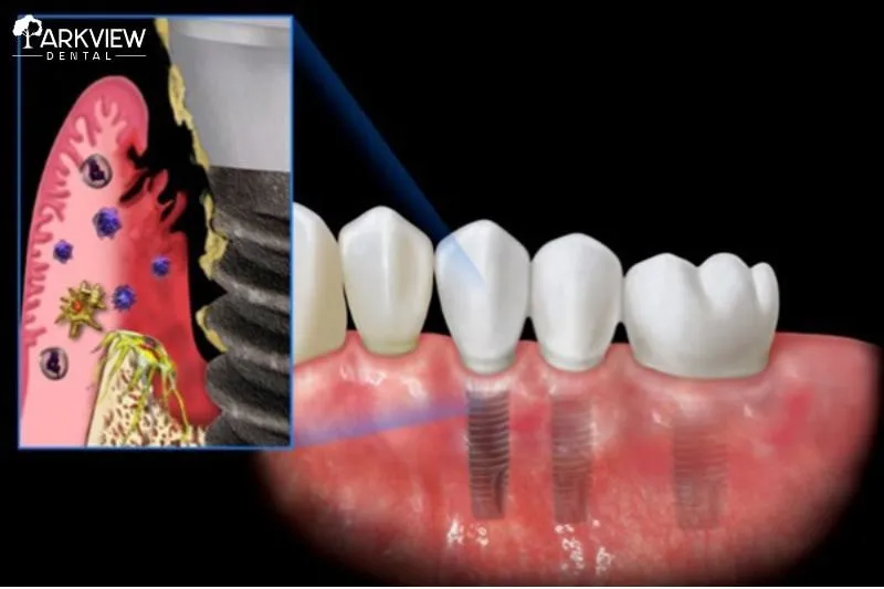 Dấu hiệu nhận biết trụ Implant bị viêm