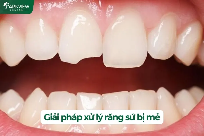 Giải pháp xử lý răng sứ bị mẻ