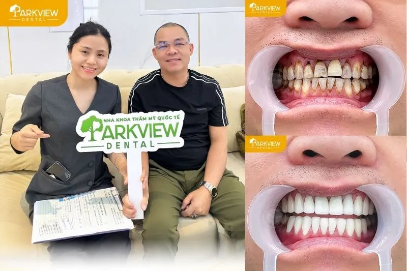 Hình ảnh khách hàng bọc sứ Lava tại Nha khoa Parkview