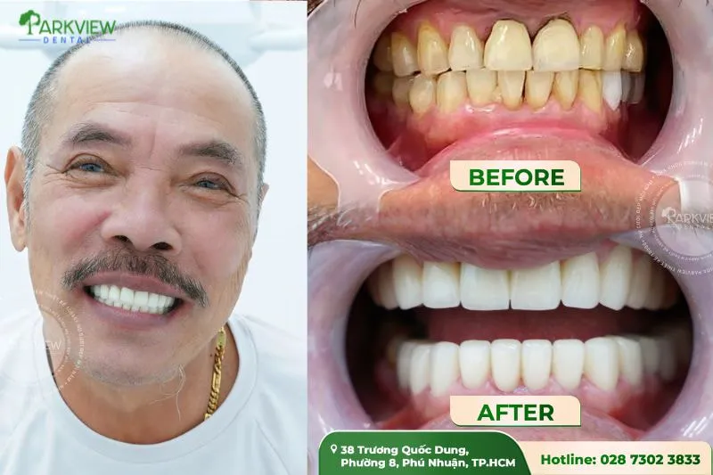 Hình ảnh khách hàng bọc răng sứ Zirconia tại Nha khoa Parkview