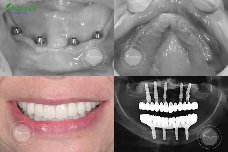 Hình ảnh khách hàng trồng răng Implant lại Nha khoa Parkview