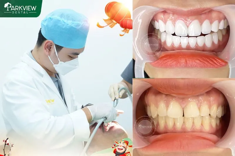 Hình ảnh khách hàng bọc răng sứ Zirconia tại Nha khoa Parkview