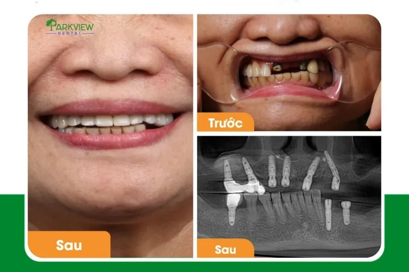 Hình ảnh trước và sau khi trồng răng implant tại Nha khoa Parkview