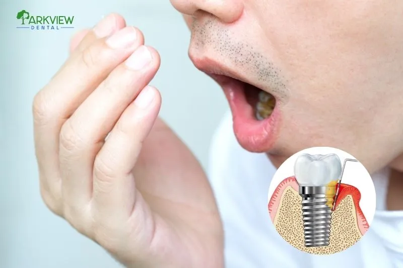 Hơi thở có mùi khó chịu sau khi trồng răng Implant