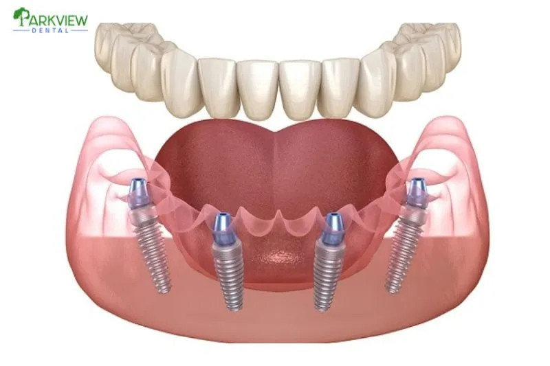 Trồng răng Implant All On 4 là phương pháp phục hồi răng toàn hàm hiện đại, sử dụng 4 trụ implant để nâng đỡ cả hàm răng cố định