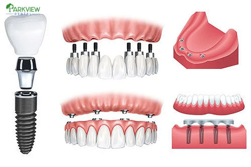 Implant All on 6 là kỹ thuật trồng răng hiện đại giúp phục hình toàn bộ hàm răng đã mất bằng cách cấy 6 trụ Implant vào xương hàm