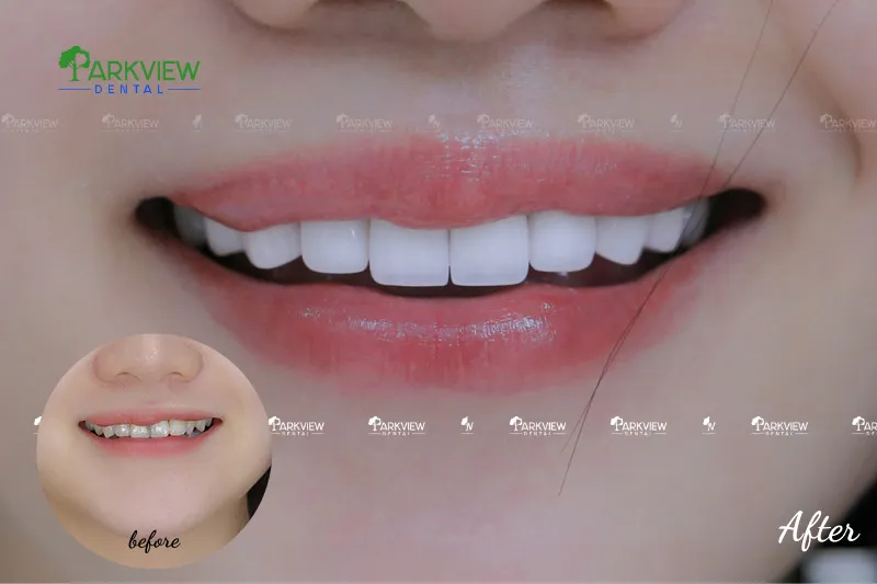 Khách hàng thực tế tại Nha Khoa Parkview cải thiện nụ cười cùng răng Lava Plus