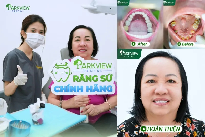 Khách hàng trước và sau khi trồng răng Implant tại Nha khoa Parkview