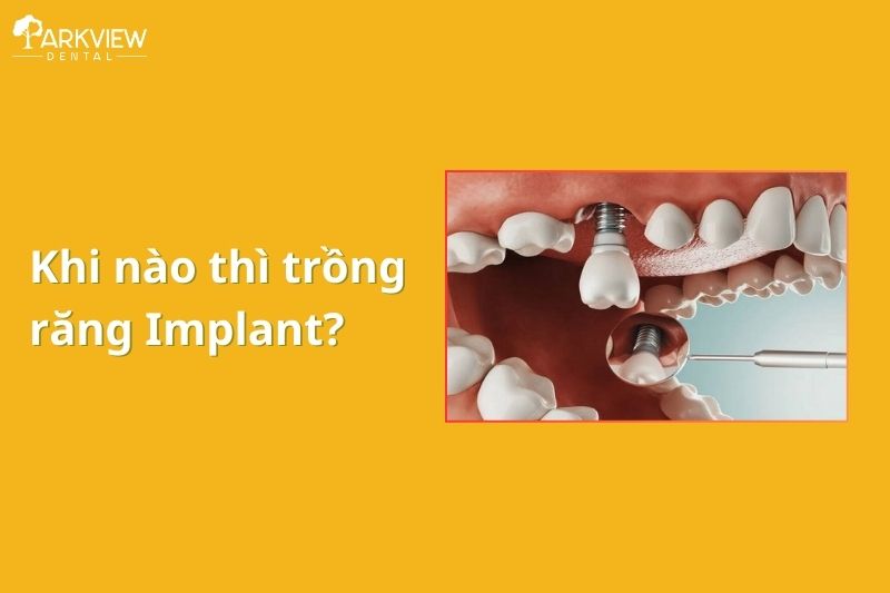 khi nào thì trồng răng implant