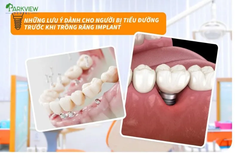 Lưu ý sau khi trồng Implant cho người bị tiểu đường