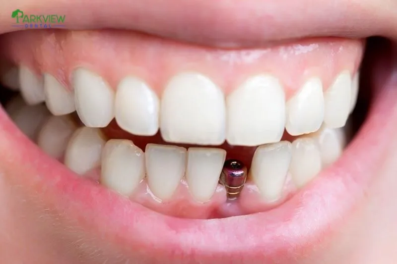 Mất răng bao lâu thì có thể trồng răng Implant