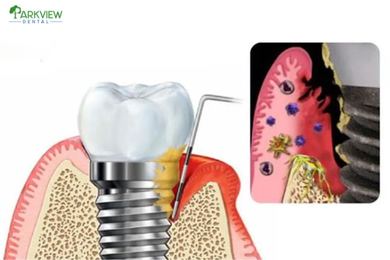 Nguyên nhân gây biến chứng trồng răng Implant