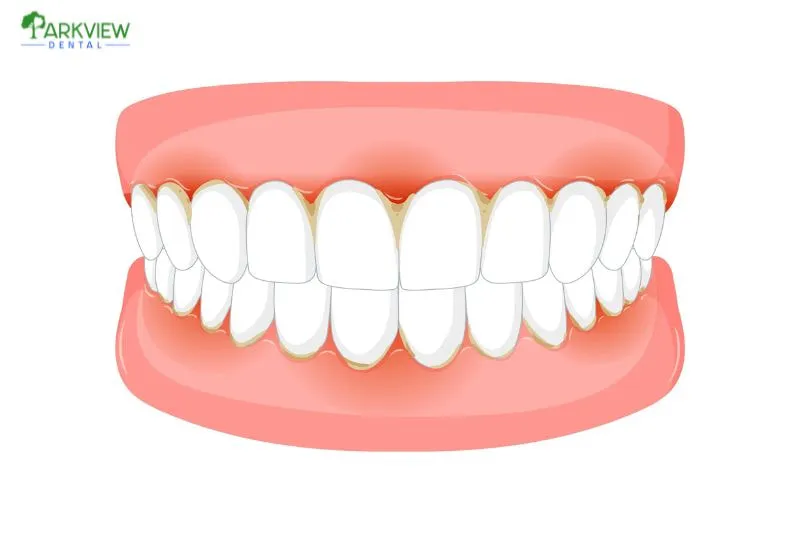 Nguyên nhân khi bọc răng sứ bị lệch khớp cắn