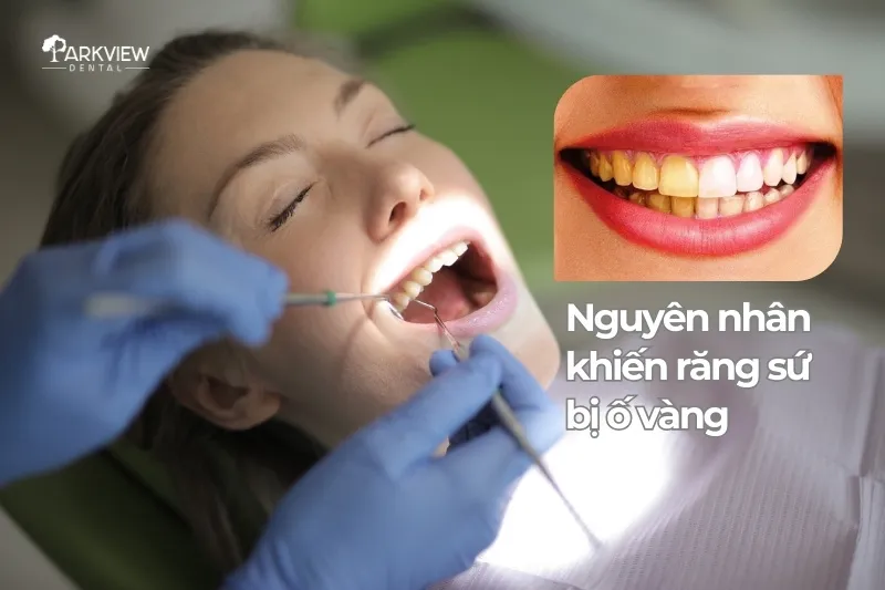 Nguyên nhân khiến răng sứ bị ố vàng