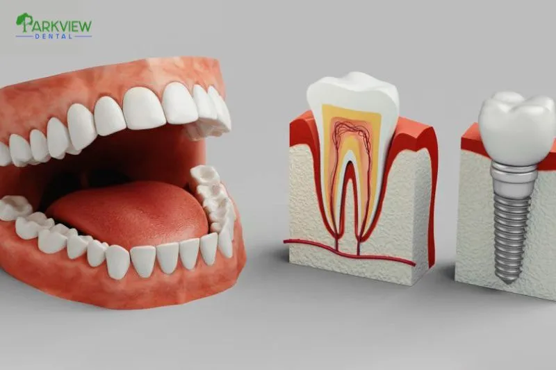 Nhược điểm của trồng răng Implant là gì?