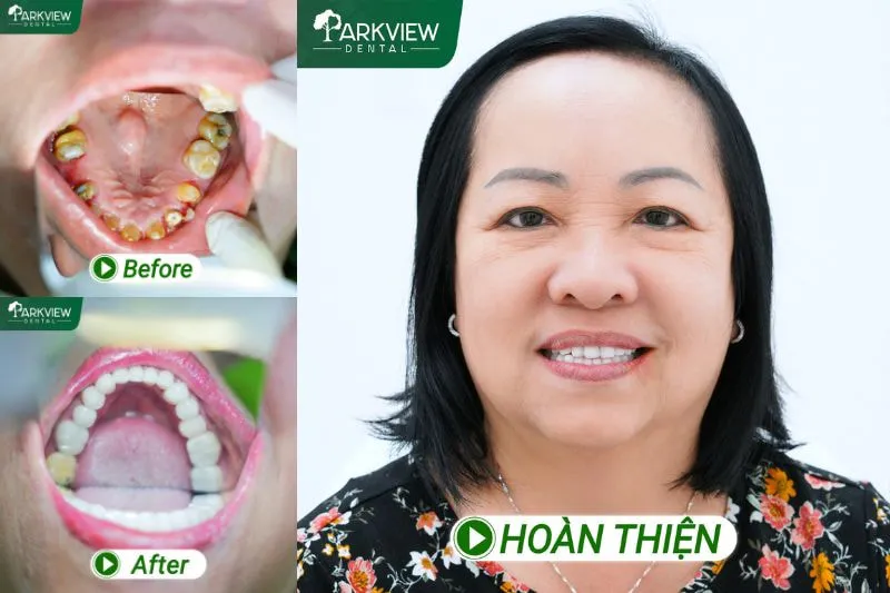Hình ảnh thực tế khách hàng cấy ghép Implant tại Nha khoa Parkview