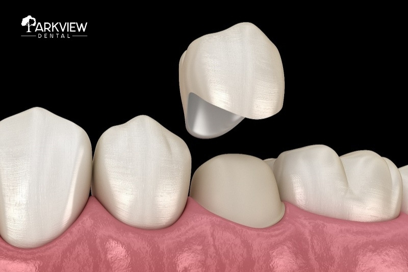 Răng sứ 800k có thật sự đáp ứng được yêu cầu thẩm mỹ và độ bền