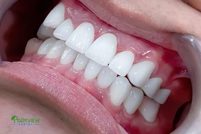 Răng sứ cao cấp trong suốt, tự nhiên như răng thật