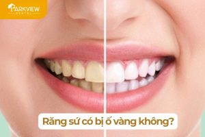 răng sứ có bị ố vàng không