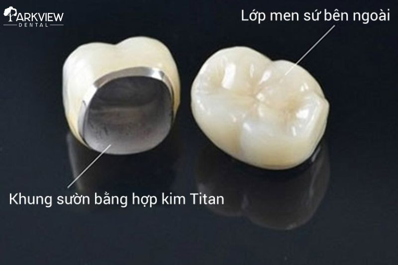 Răng sứ kim loại titan
