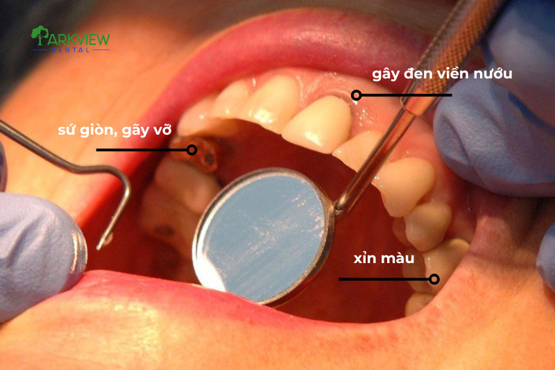 Rủi ro về chất lượng của răng sứ giá rẻ