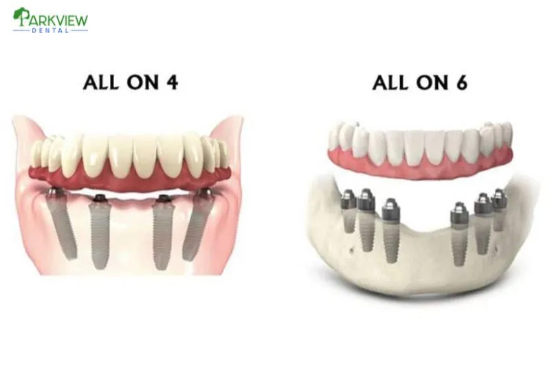 Sự khác nhau giữa All On 4 và All On 6