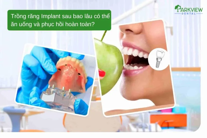 Trồng răng Implant sau bao lâu có thể ăn uống và phục hồi hoàn toàn
