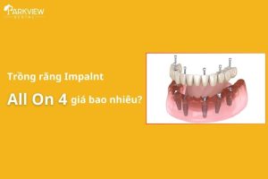trồng răng implant all on 4 giá bao nhiêu