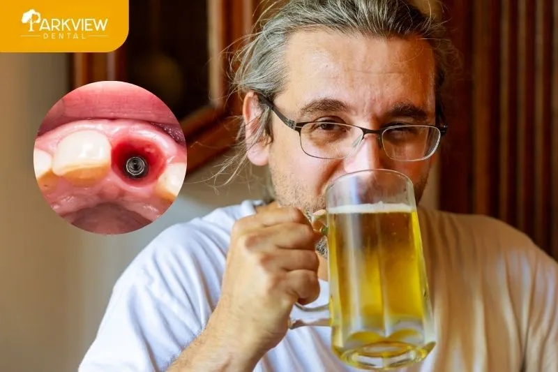 Trồng răng Implant bao lâu thì uống bia được?