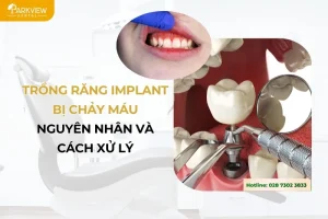Trồng Răng Implant Bị Chảy Máu – Nguyên Nhân Và Cách Xử Lý