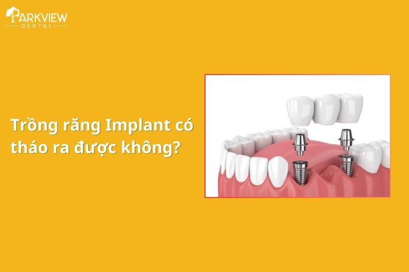 trồng răng implant có tháo ra được không