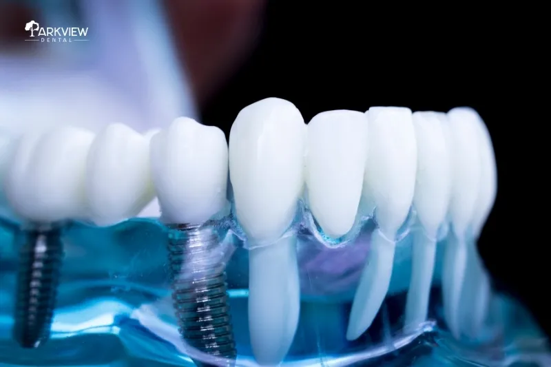 Trồng răng implant giải pháp phục hình răng đã mất
