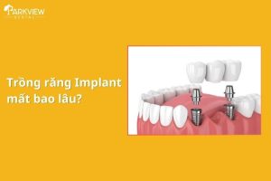 trồng răng implant mất bao lâu
