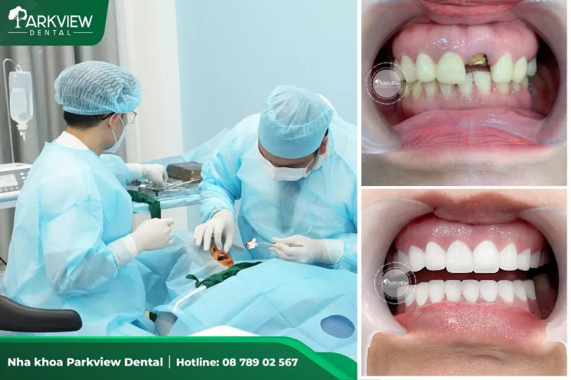 Trồng răng Implant tại Nha khoa Parkview do bác sĩ giàu kinh nghiệm trực tiếp thực hiện.