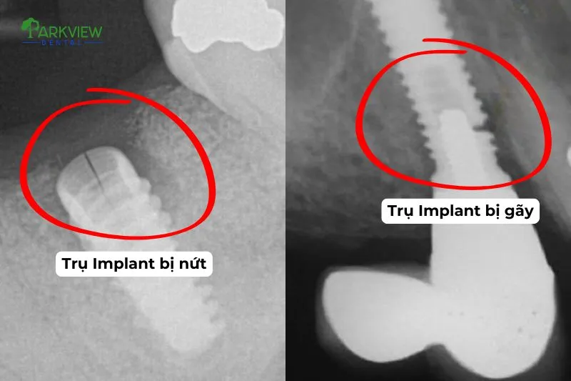 Trụ Implant bị vỡ, gãy do lực nhai quá mạnh