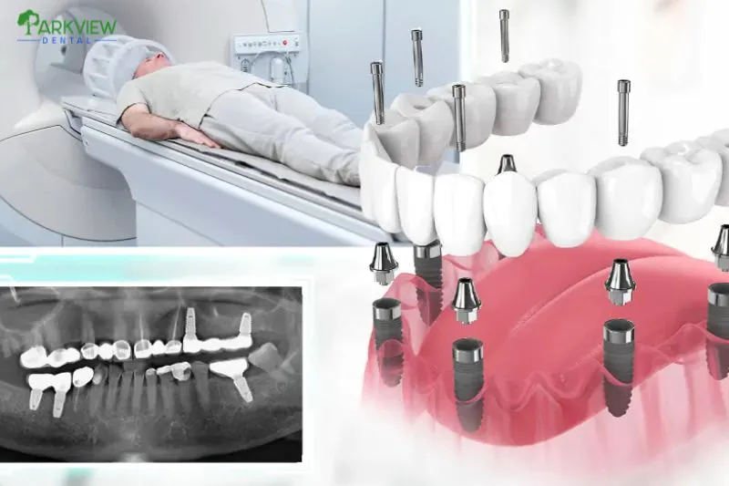 Trụ Implant có ảnh hưởng khi chụp MRI không?