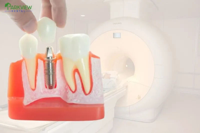 Những trường hợp cần lưu ý khi chụp MRI sau khi trồng Implant